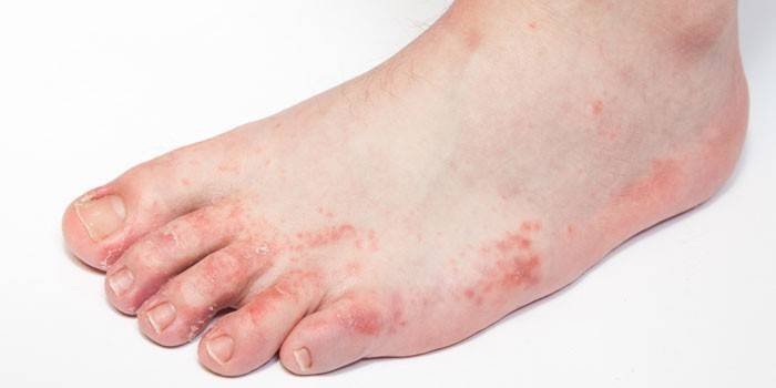 Dermatitis a lábán
