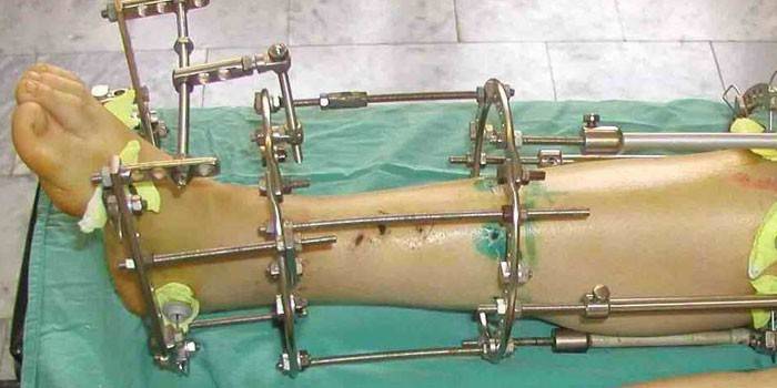 Appareil d'Ilizarov sur la jambe