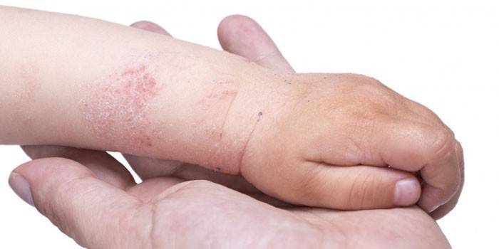 Ekzeme an der Hand eines Kindes