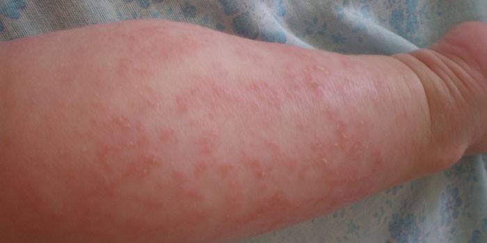 Dermatitisz gyermekkorban