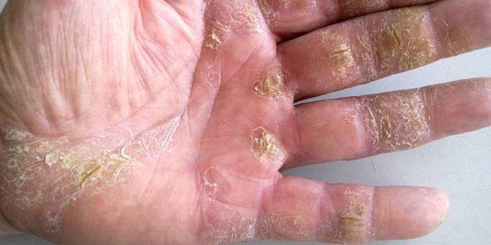 Palm psoriasis