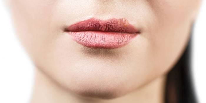مظهر من الهربس على الشفة