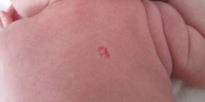 Hemangioma en el cuerpo del bebé.