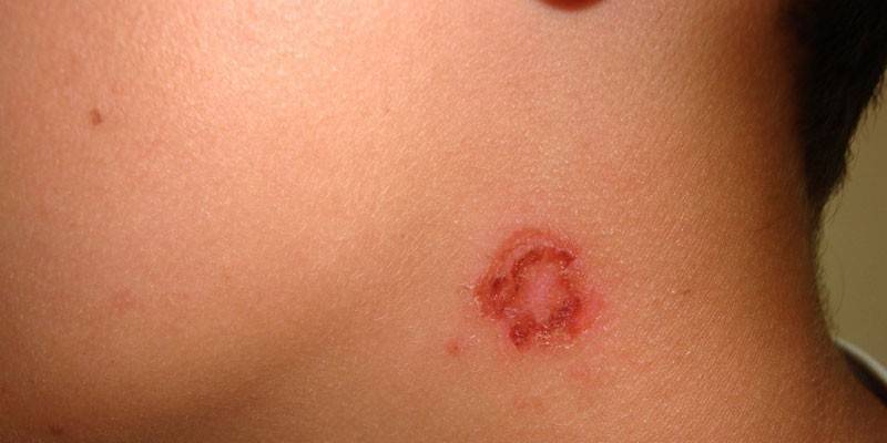 Streptokokal impetigo