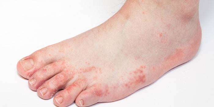 Manifestações de dermatite alérgica no pé