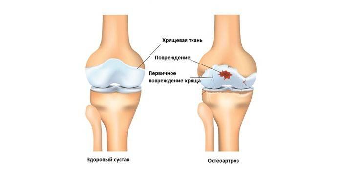 Joelho saudável e osteoartrite