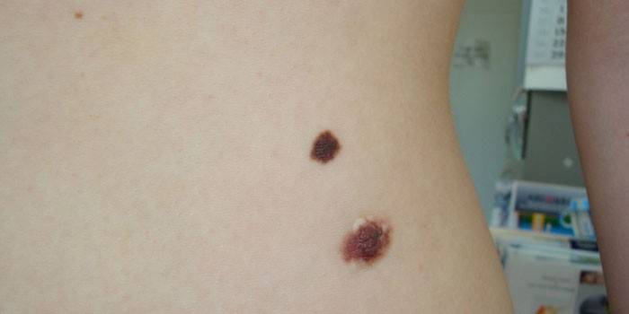 Pigmentinis nevus ant kūno