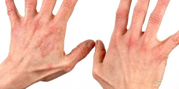A psoriasis kezdeti stádiuma egy férfi karjában
