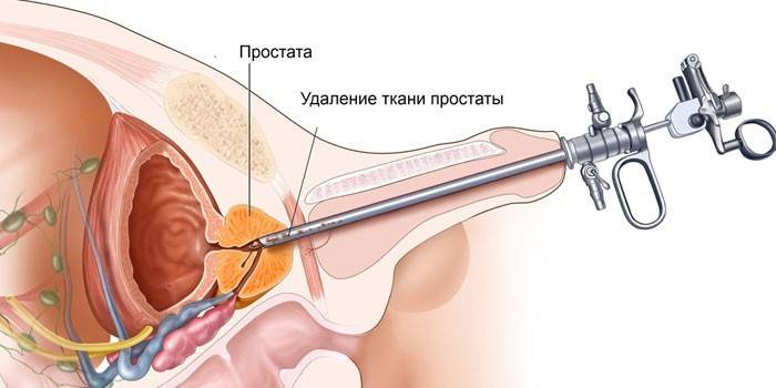 Đề án cắt bỏ xuyên giáp