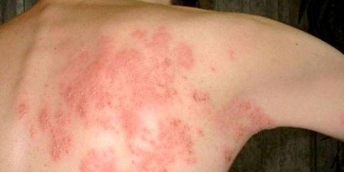 Odos odos dermatomikozės pasireiškimas žmonėms