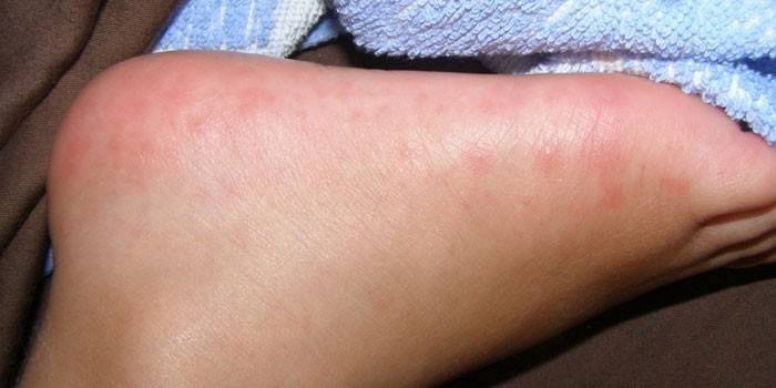 Enterovirus phát ban ở bàn chân