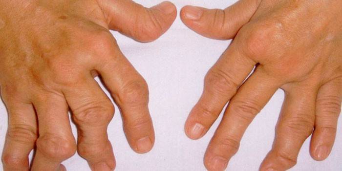 Artritis reumatoide de las manos