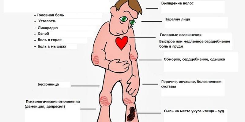 Boreliozės simptomai