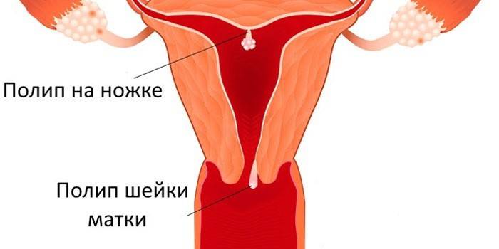 Polyyppien ja niiden tyyppien sijoitus kohdussa