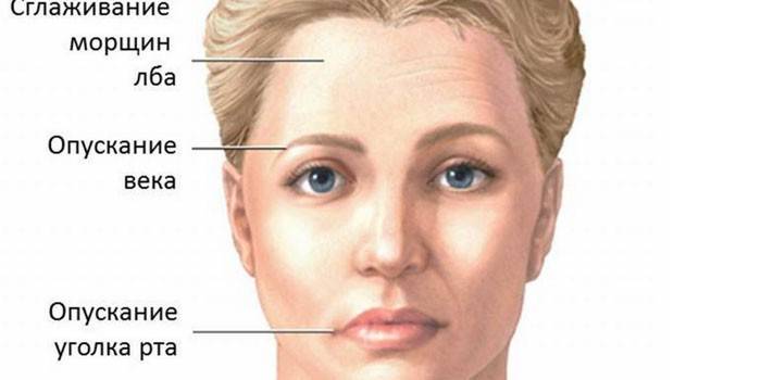 Sinais de neurite facial