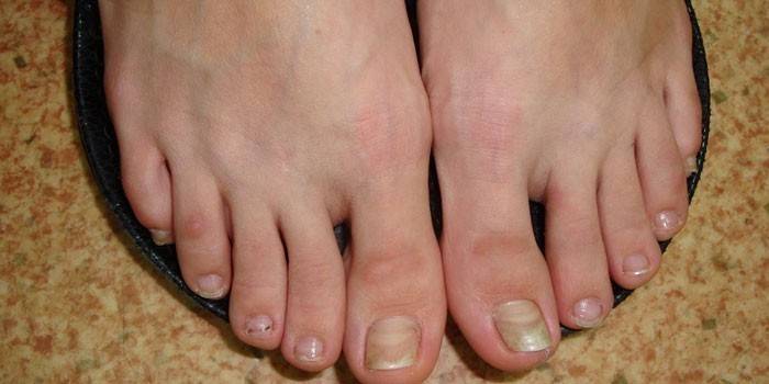 Onychomycose des pieds