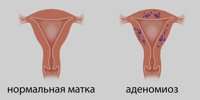 Normali gimda ir gimda su adenomioze