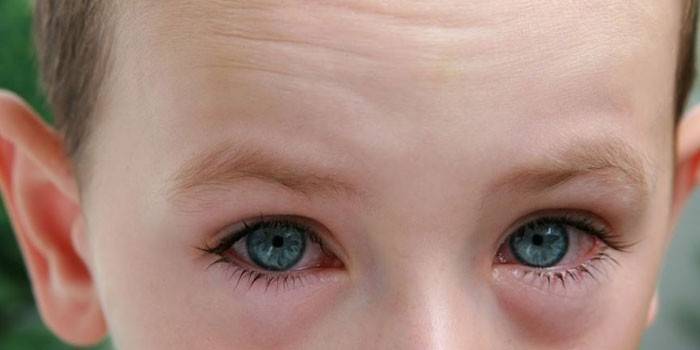Hinchazón de los ojos en un niño.