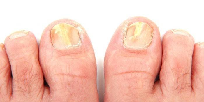 Toenail grybelis