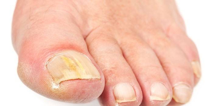 Nagelpilz