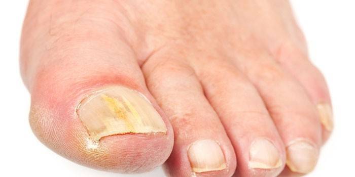 Champignon des ongles