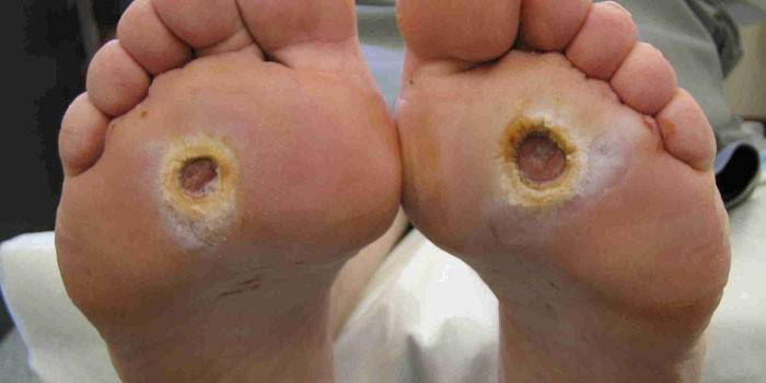 ขั้นตอนที่สามของการพัฒนาของแผลเบาหวานในเท้ามนุษย์