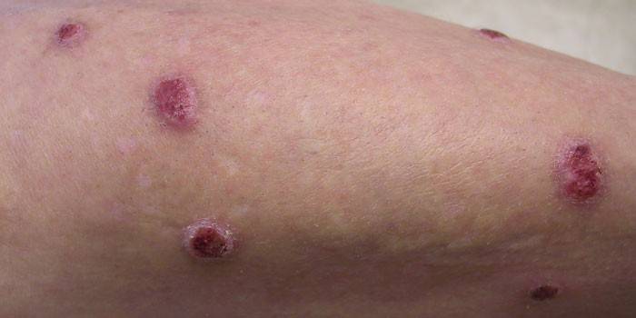 Papular urticaria på huden på hånden