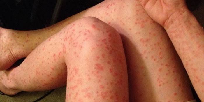 Plăcile psoriazice ale corpului