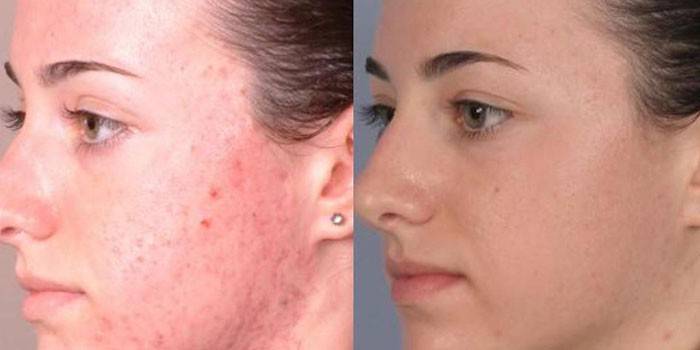 Foto da pele do rosto da menina antes e depois da plasmaferese