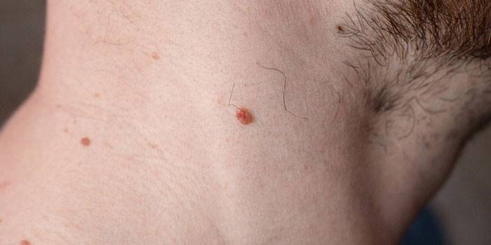 Papillomi sul collo di un uomo