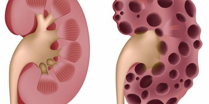 Riñón sano y riñón afectado por síndrome de insuficiencia renal