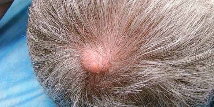 Ateroma sulla testa