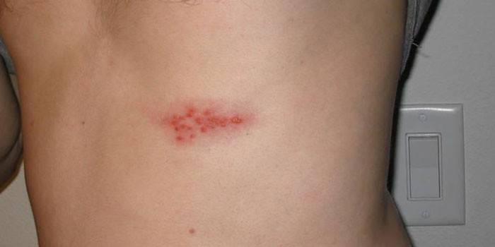 Gürtelrose auf dem Bauch eines Mannes