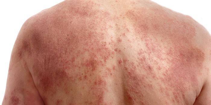 Kolinerge urticaria på ryggen