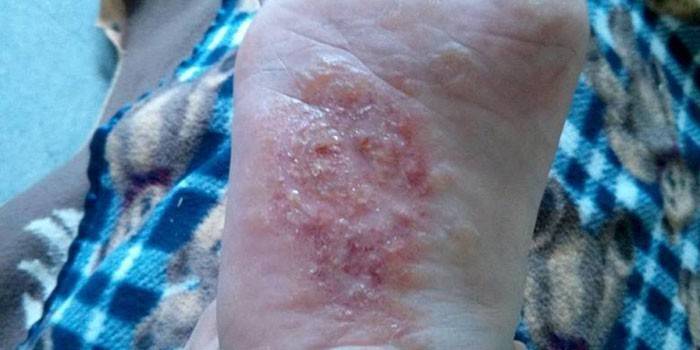 Eczéma dyshidrotique sur le pied