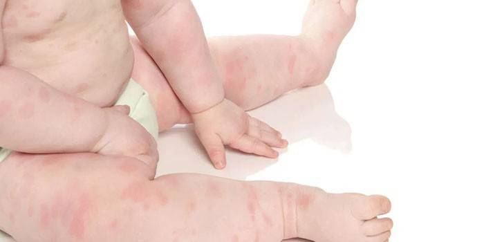 Μωρό στο Papules