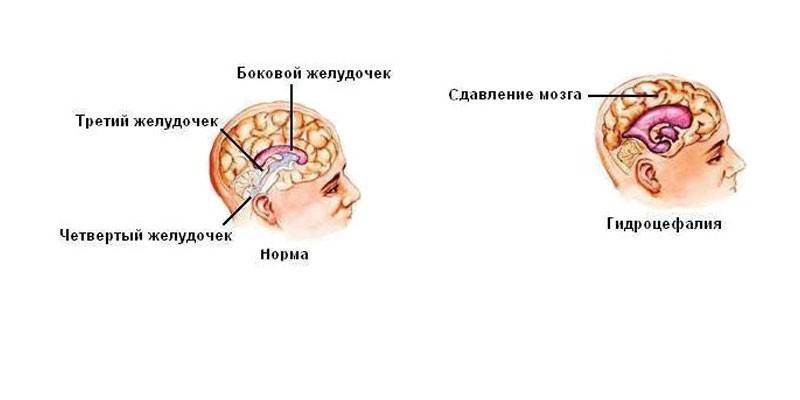 Hipertensīva encefalopātija