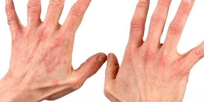 โรคสะเก็ดเงินบนผิวหนังของมือ