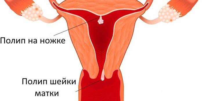 Локације и врсте полипа матернице