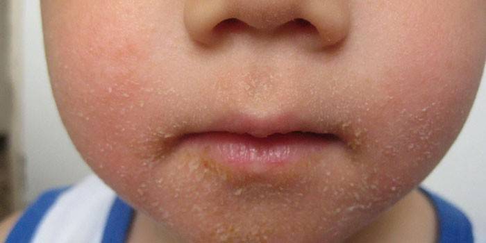 Streptoderma pe chipul unui copil