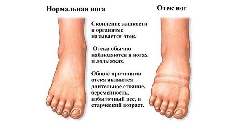 Causes of leg swelling