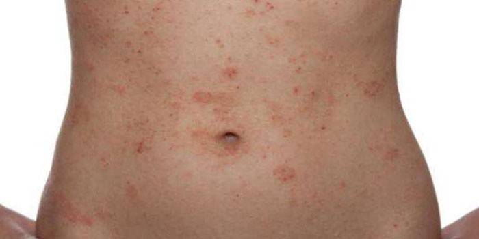 Allergiás dermatitis a testben