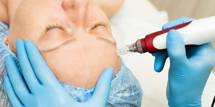 Frakcyjna mezoterapia w salonie