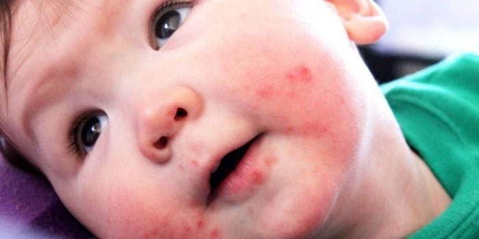 Enterovirus phát ban trên mặt của một đứa trẻ