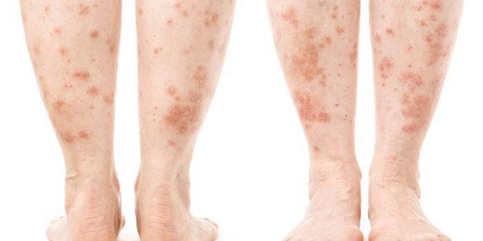 Psoriasis en las piernas.