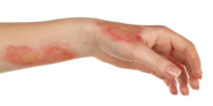 Brucia sulla pelle della mano