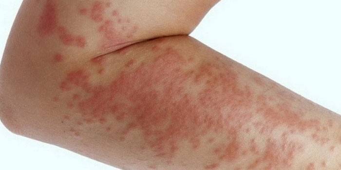 Eruzione cutanea allergica
