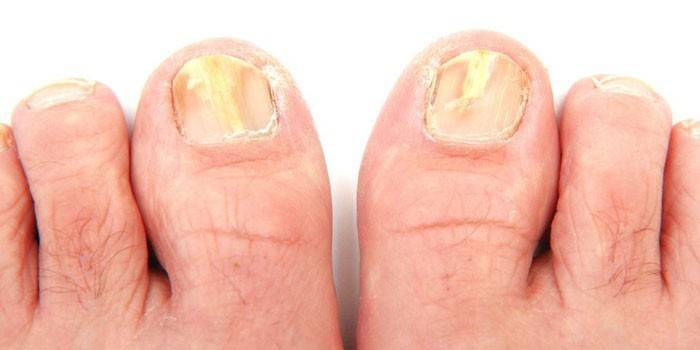 Nagelpilz