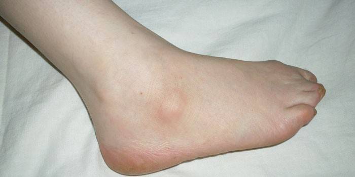 Lipoma ở chân
