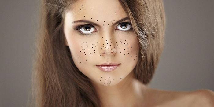 Những chấm đen trên khuôn mặt cô gái